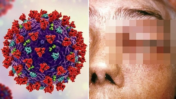 인도에서 코로나 확산으로 고통 받는 환자들 사이에 치명적인 털곰팡이균이 급속도로 퍼지고 있다.(사진제공 = 위클리코리아)